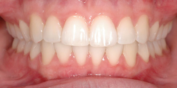 Case 1 After Orthodontic Treatment