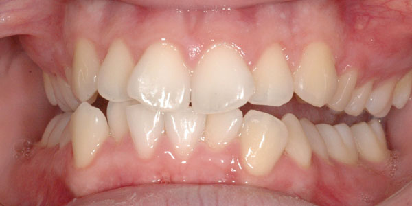 Case 1 Before Teeth Straightening