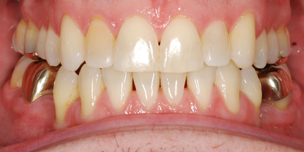 Case 2 After Orthodontic Treatment