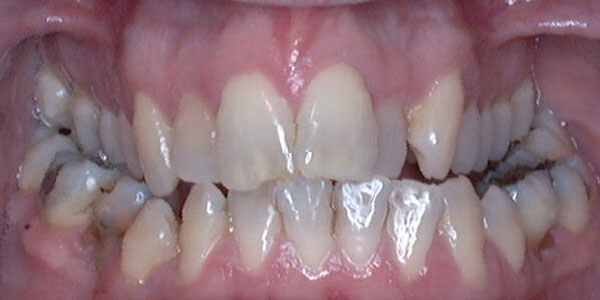 Case 2 Before Teeth Straightening