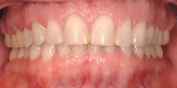 Case 3 After Teeth Straightening