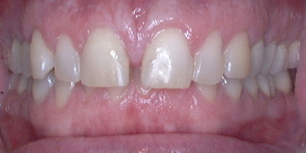 Case 3 Before Teeth Straightening