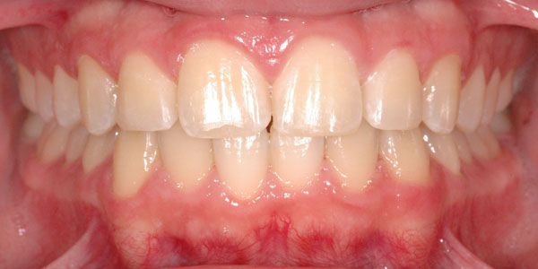 Case 4 After Orthodontic Treatment