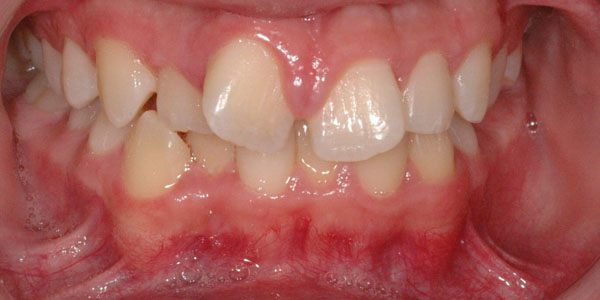 Case 4 Before Teeth Straightening