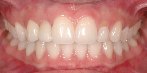 Case 5 After Teeth Straightening