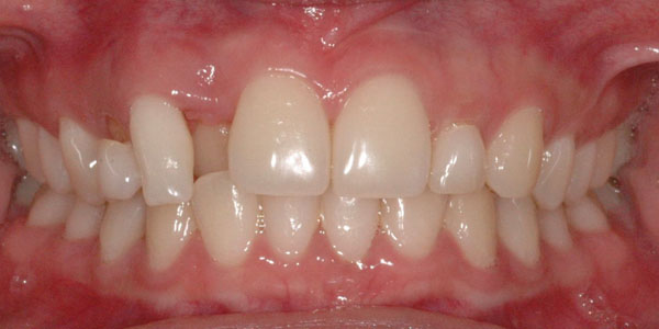 Case 5 Before Teeth Straightening