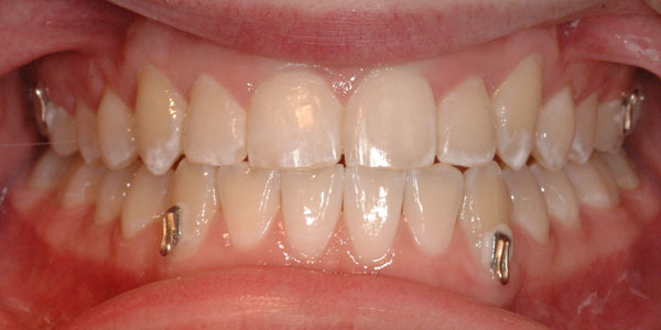 Case 6 After Orthodontic Treatment