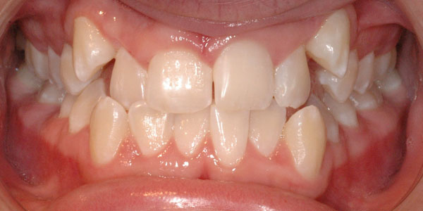 Case 6 Before Teeth Straightening