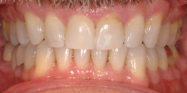 Case 7 After Teeth Straightening