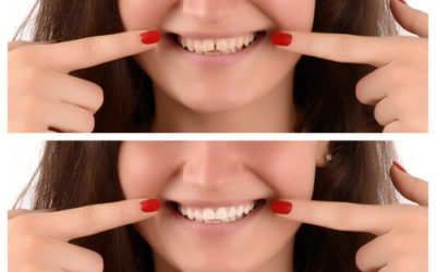Tooth Gaps: What Are My Solutions?