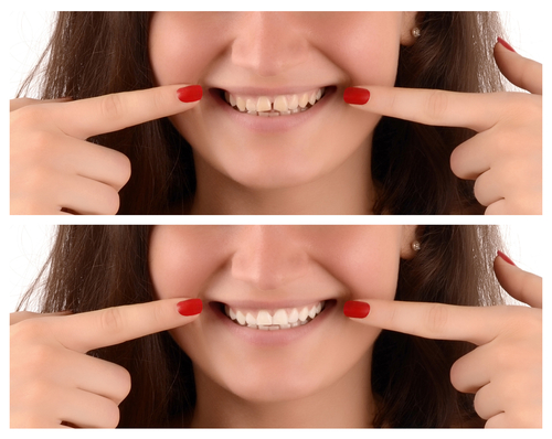 Tooth Gaps: What Are My Solutions?