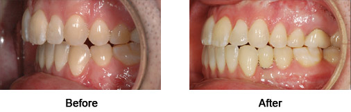 Before and After Teeth Straightening